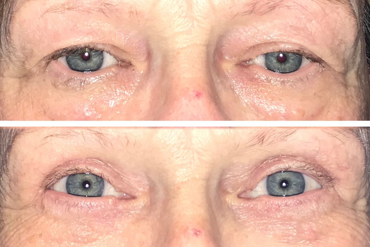 Eyelid Surgery St Petersburg Clearwater Tampa And Largo Eye Institute